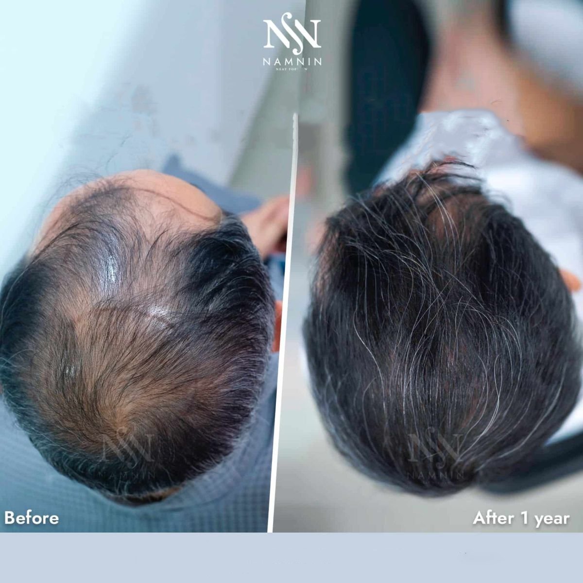 Before and after hair transplant results at Namninforv Clinic – fuller hair after 1 year