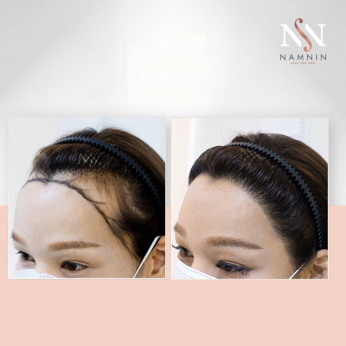 Before and after female hair transplant results at Namninforv Clinic, fuller hairline shown