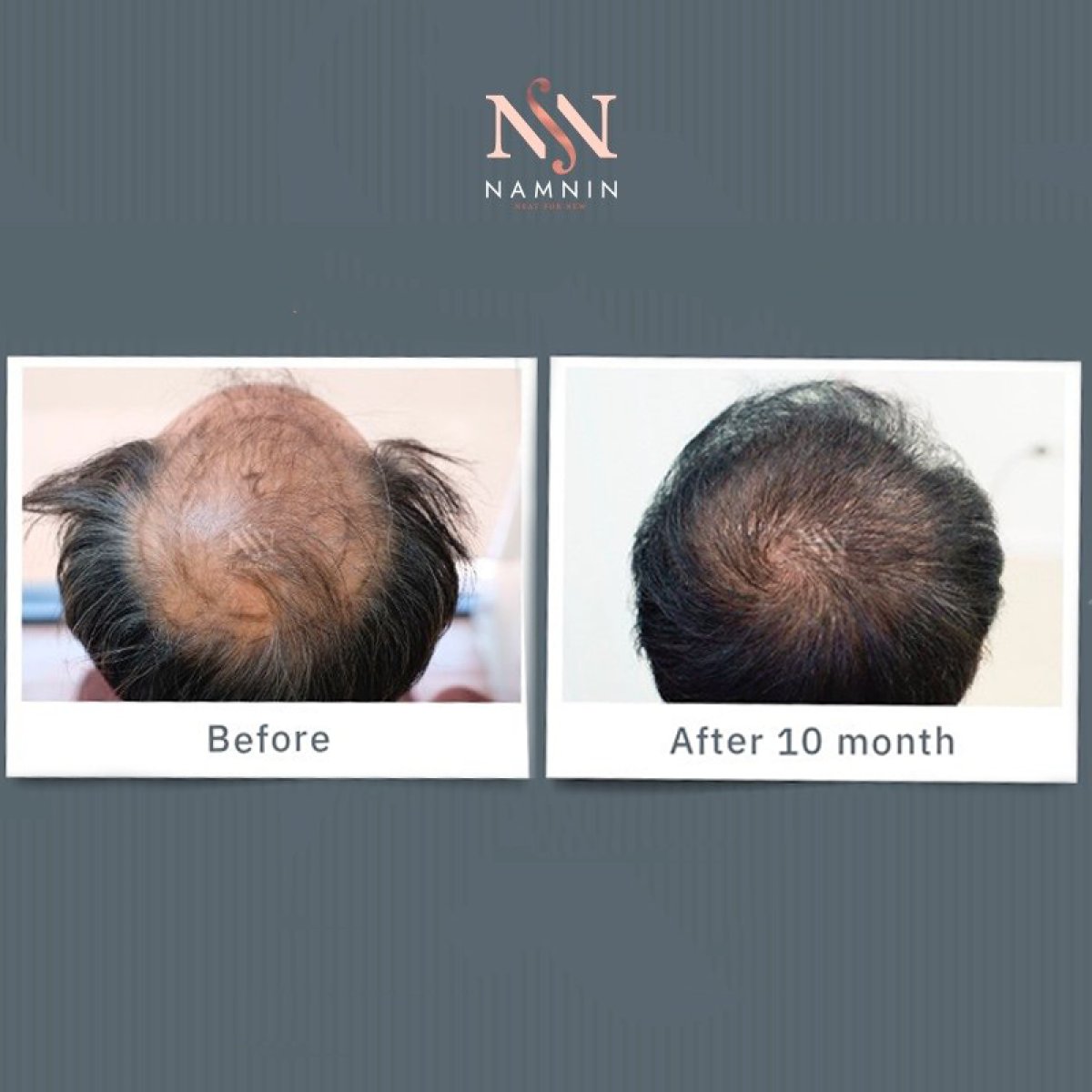 Before and after DHI hair transplant results at Namninforv Clinic, visible hair growth improvement