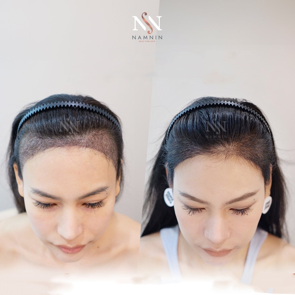 Female hair transplant before and after results at Namninforv Clinic, improved hairline density