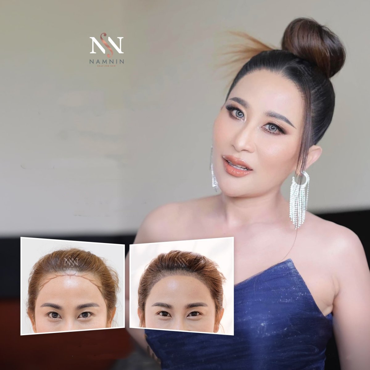 Female hair transplant before and after results at Namninforv Clinic, fuller hairline achieved