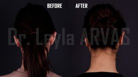 Before and after Otoplasty (ear surgery) photos by Dr. 