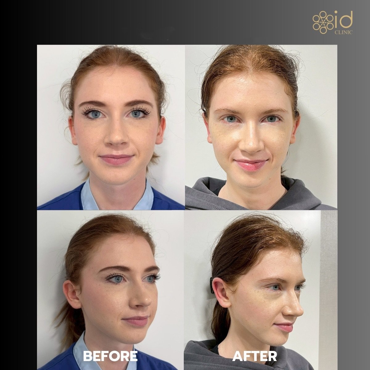 Результаты отопластики до и после в ID Clinic Bangkok, коррекция ушей для естественного вида