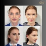 Résultats de la procédure Otoplastie (chirurgie des oreilles) par le Dr Dr Phatcharasak Kraisornphongsakul Md - Photos avant et après des patients Photos avant et après par le Dr Dr Phatcharasak Kraisornphongsakul Md