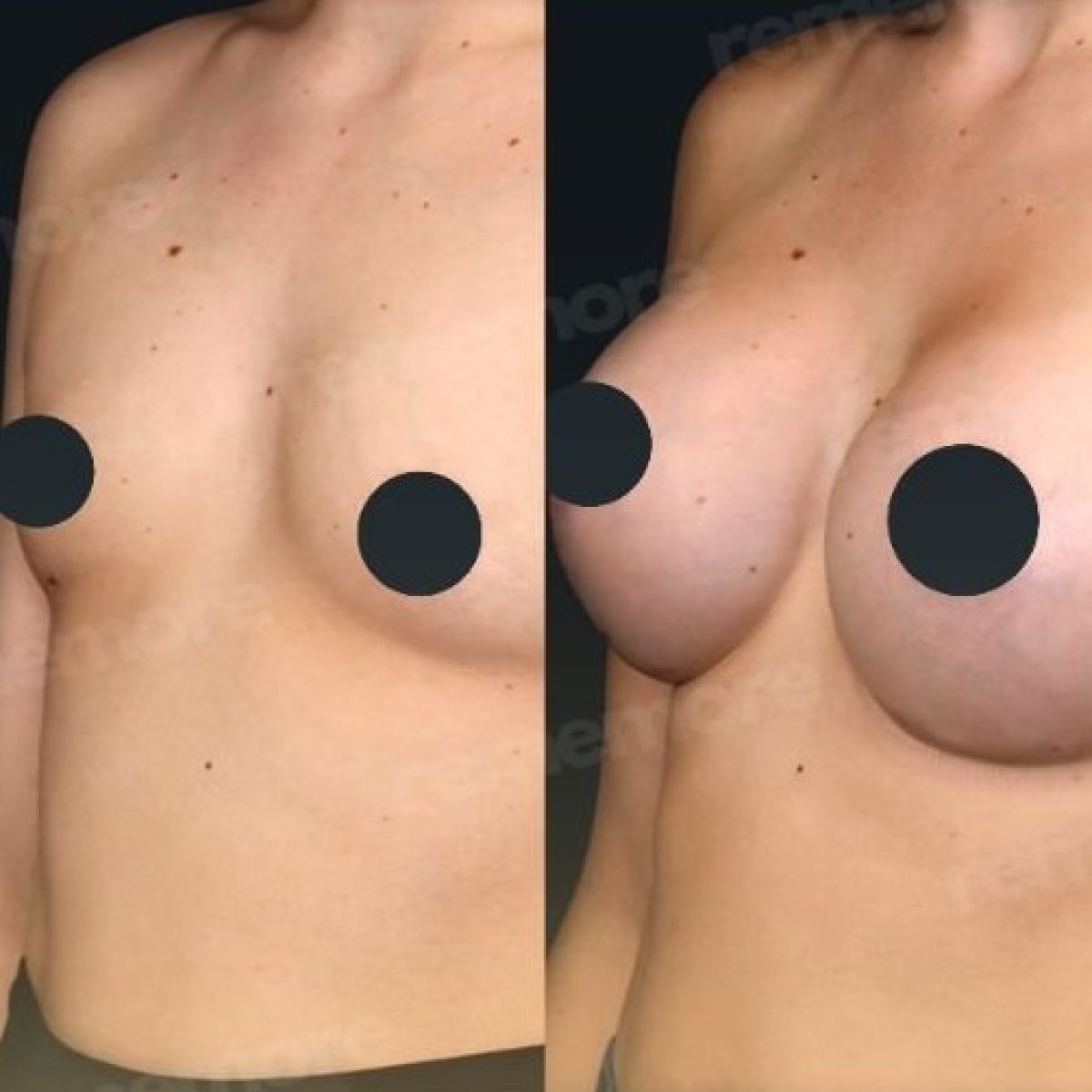 Before and after breast augmentation results at Memorial Şişli Hospital, enhanced breast shape