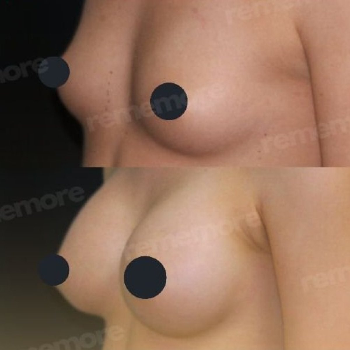 Before and after breast augmentation results at Memorial Şişli Hospital, enhanced breast shape