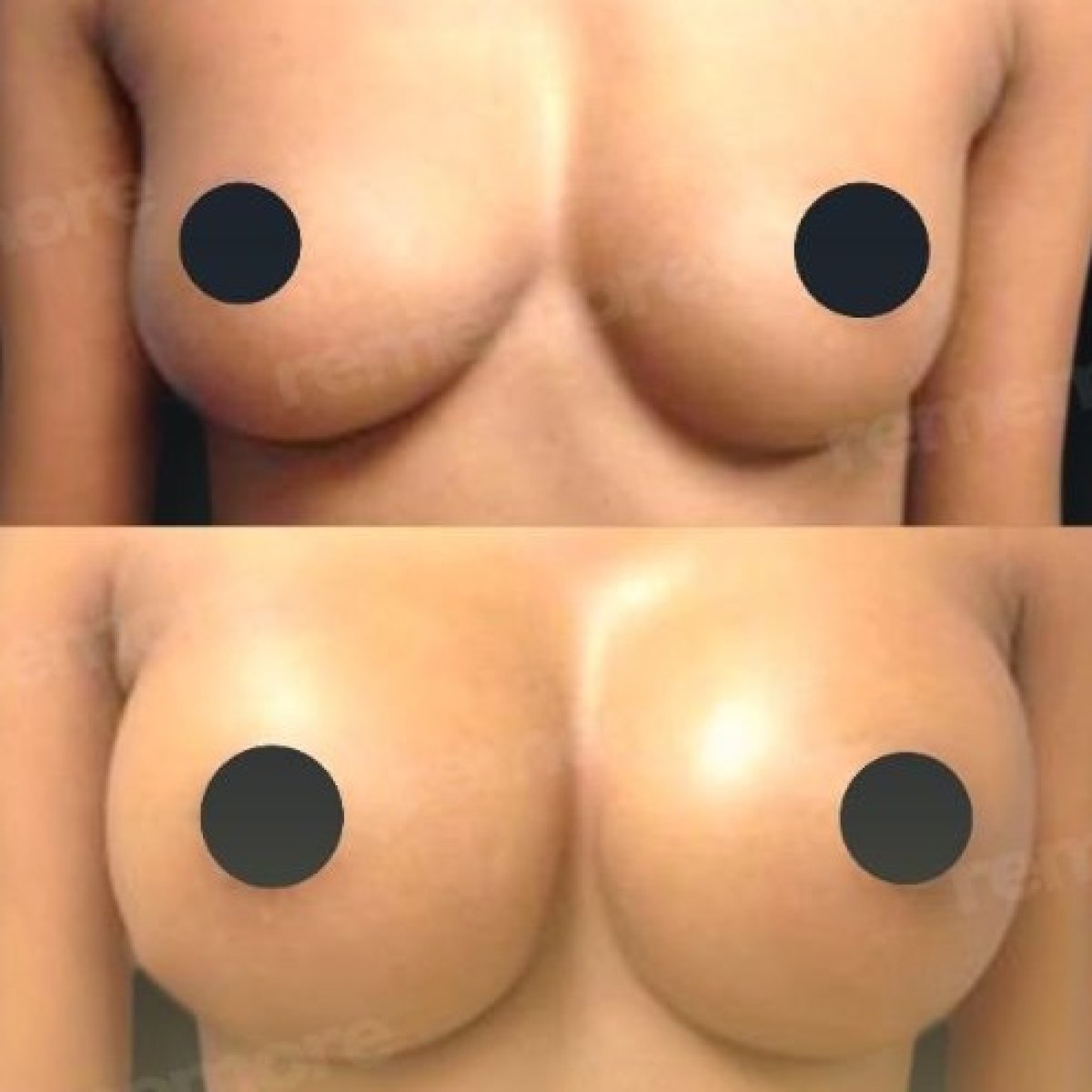 Before and after breast augmentation results at Memorial Şişli Hospital, enhanced breast volume