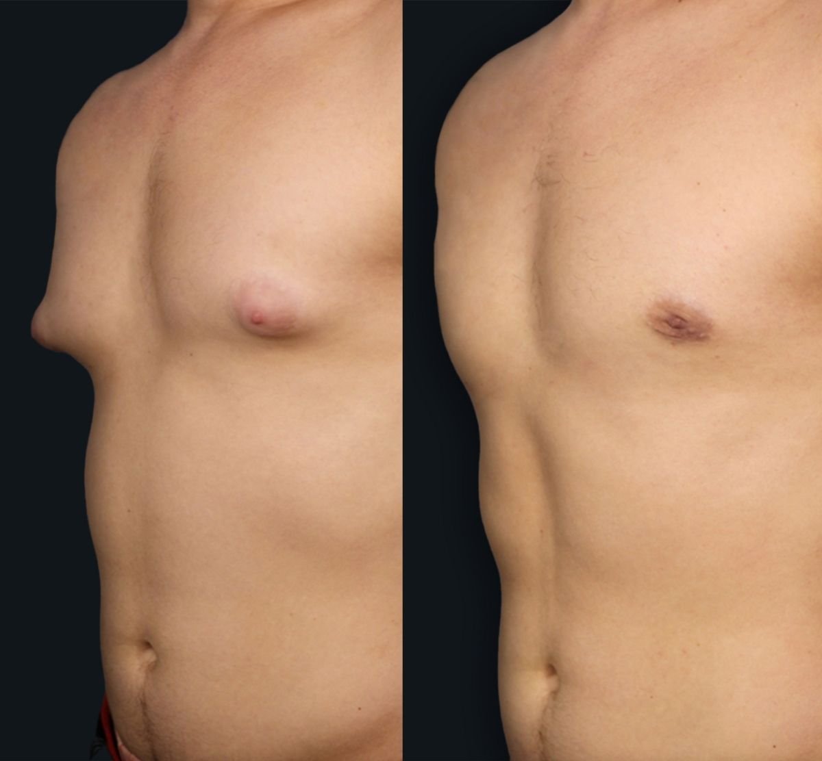 Résultats avant/après liposuccion Vaser du torse masculin à Memorial Şişli Hospital