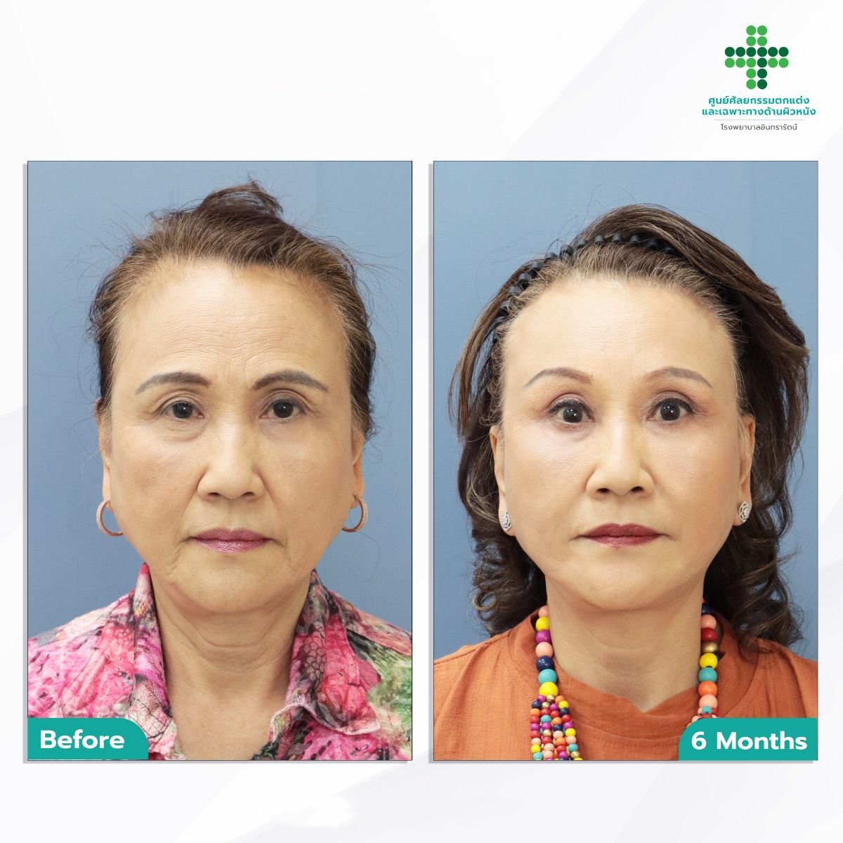 Facelift before and after results at Intrarat Hospital – visible facial rejuvenation at 6 months