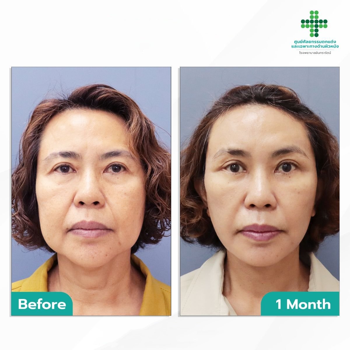 Resultados de lifting facial antes y después en Intrarat Hospital, rejuvenecimiento tras 1 mes