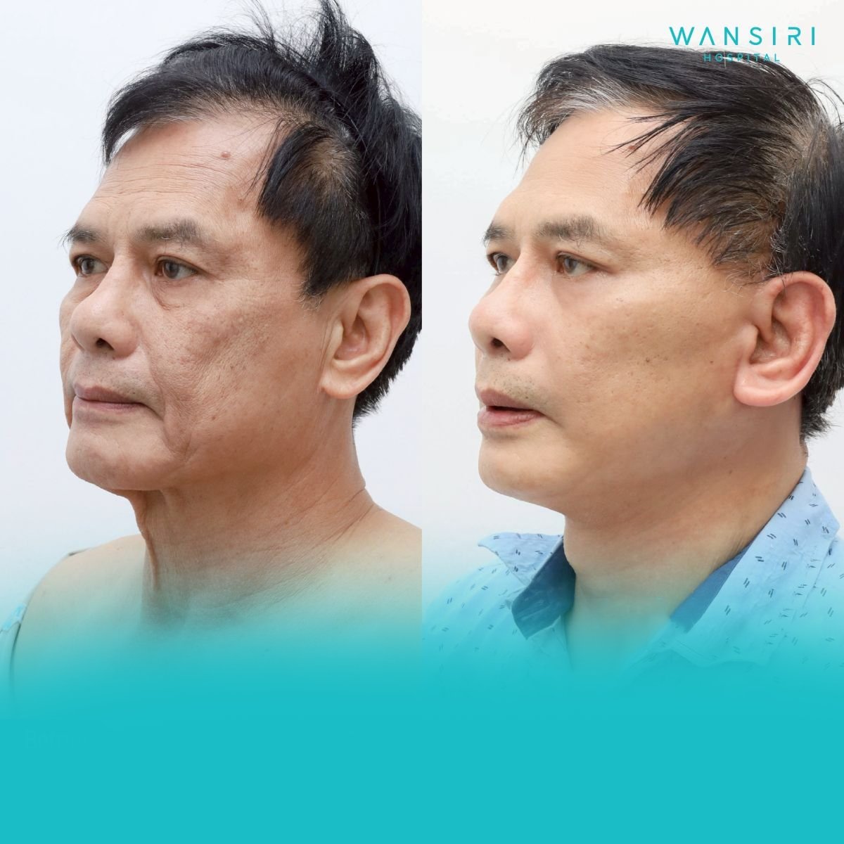 Facelift before and after results at Wansiri Hospital, visible facial rejuvenation and lift