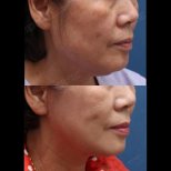 Fotos vor und nach Facelift durch Dr. Jung Young Choon