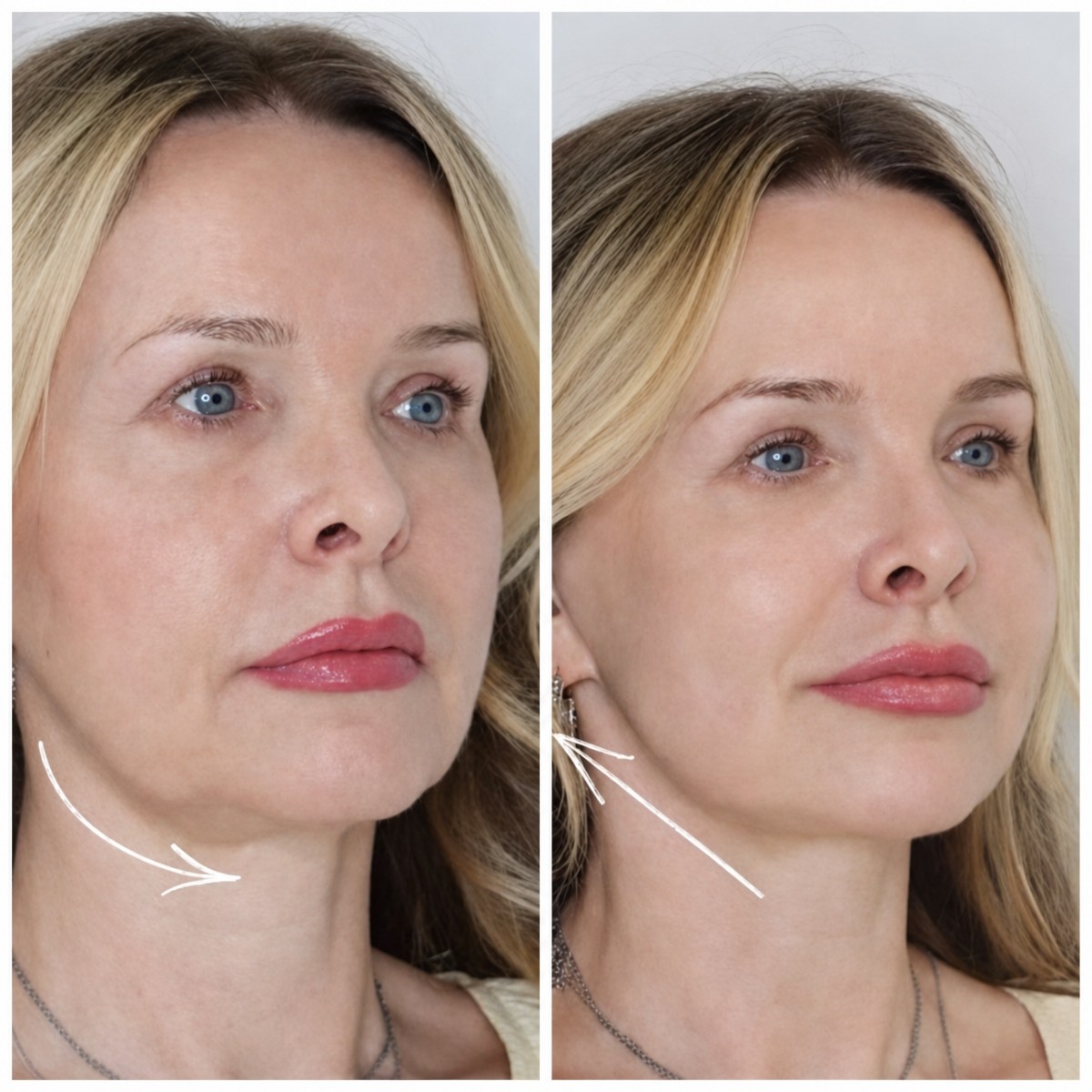 Resultados de minilifting facial en Altos Clinic: elevación visible de mandíbula y cuello