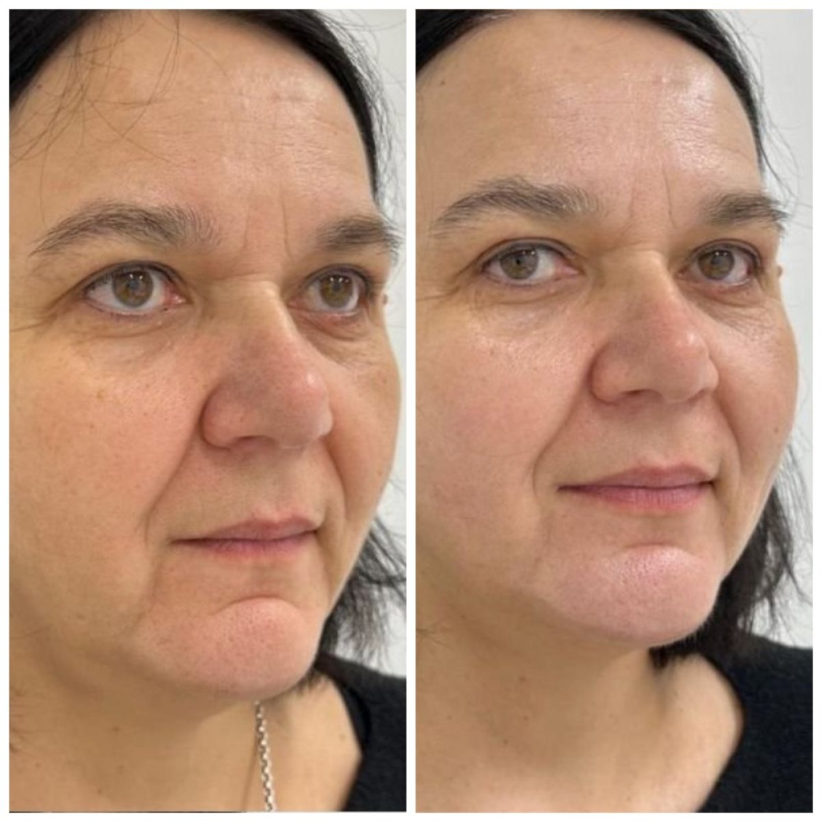Résultats avant/après mini lifting du visage à Altos Clinic – rajeunissement visible
