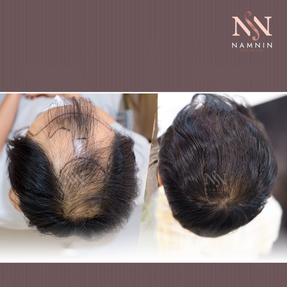 Résultats avant/après greffe de cheveux DHI à Namninforv Clinic – densité restaurée
