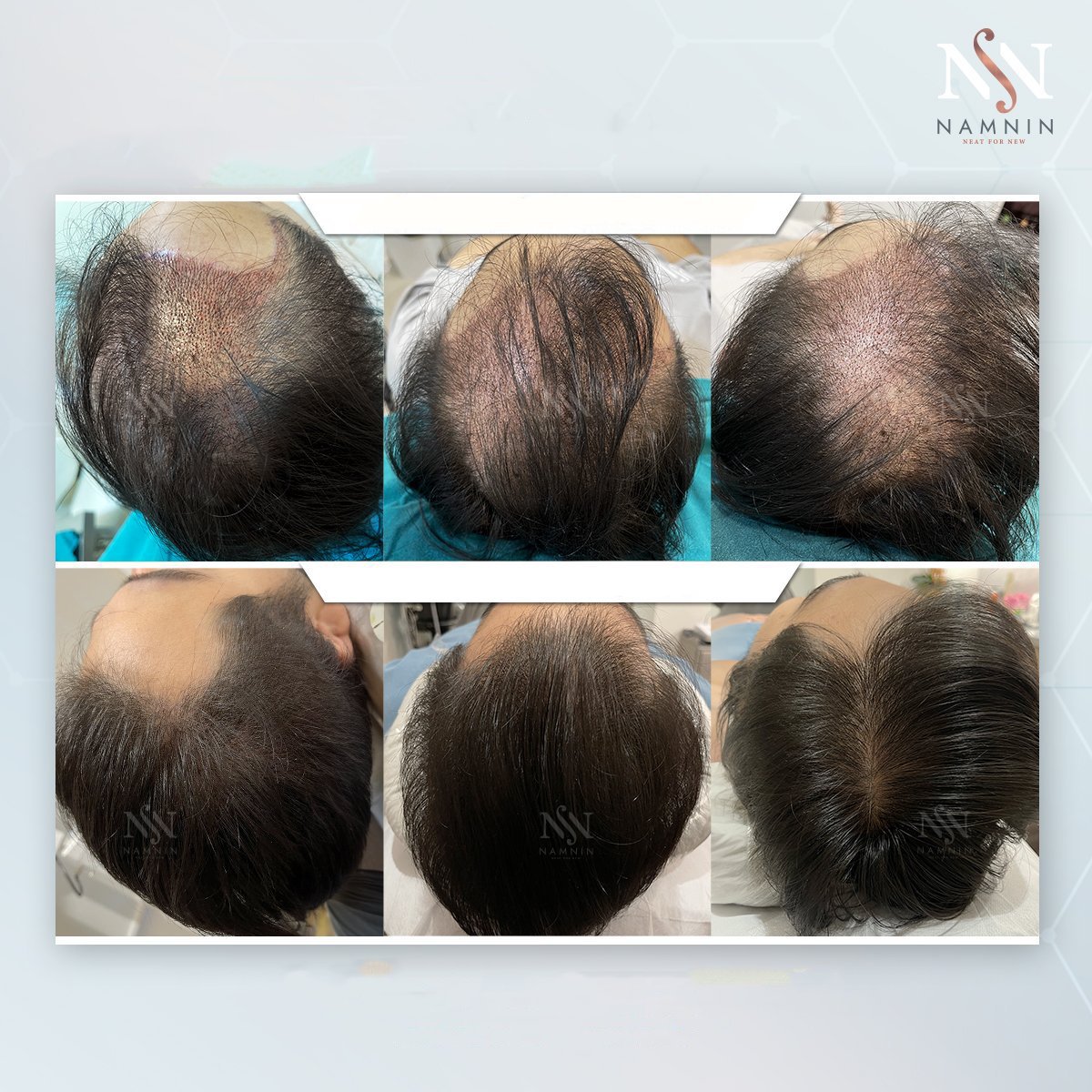 Before and after DHI hair transplant results at Namninforv Clinic, improved hair density