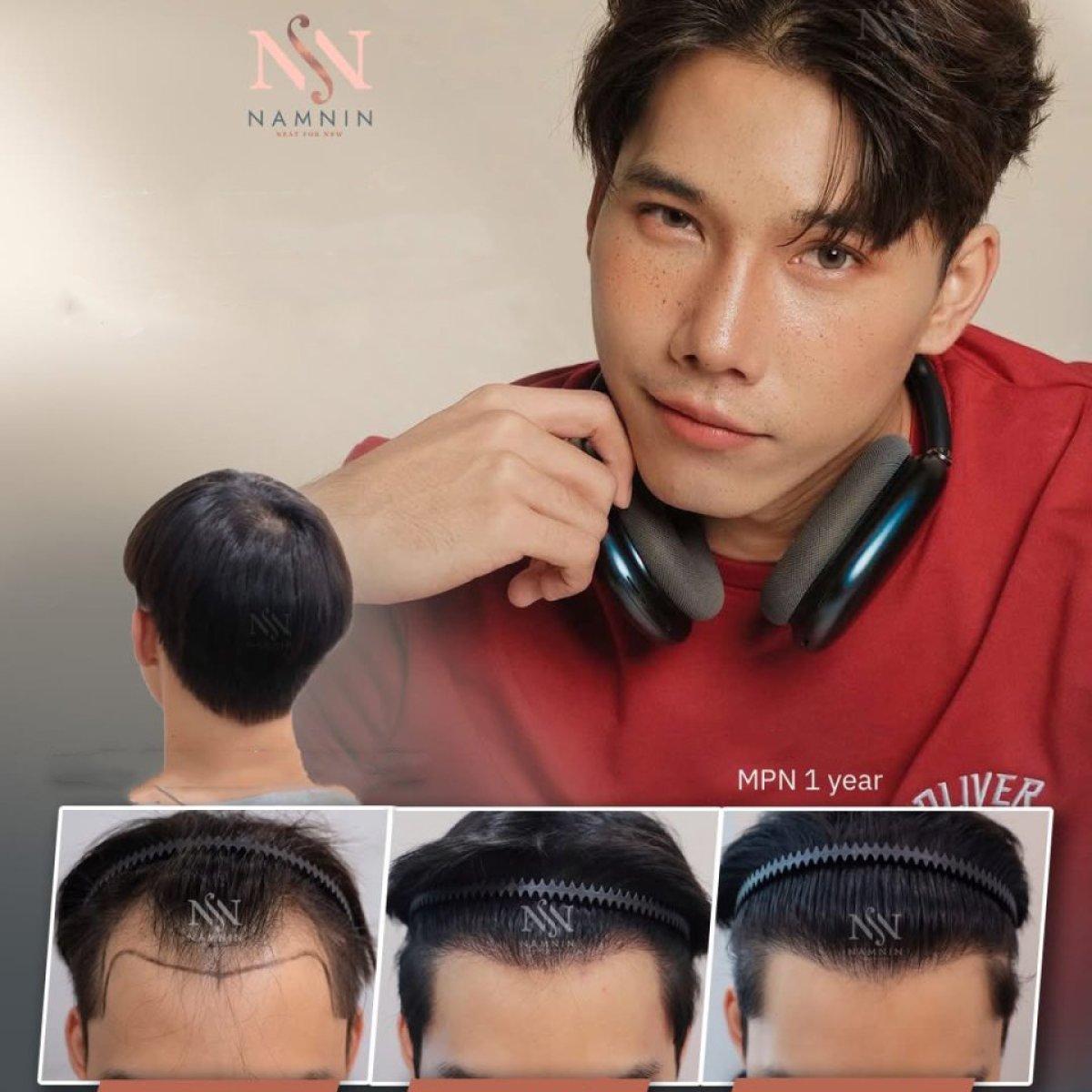 نتائج زراعة الشعر FUE قبل وبعد في عيادة Namninforv، استعادة خط الشعر خلال عام