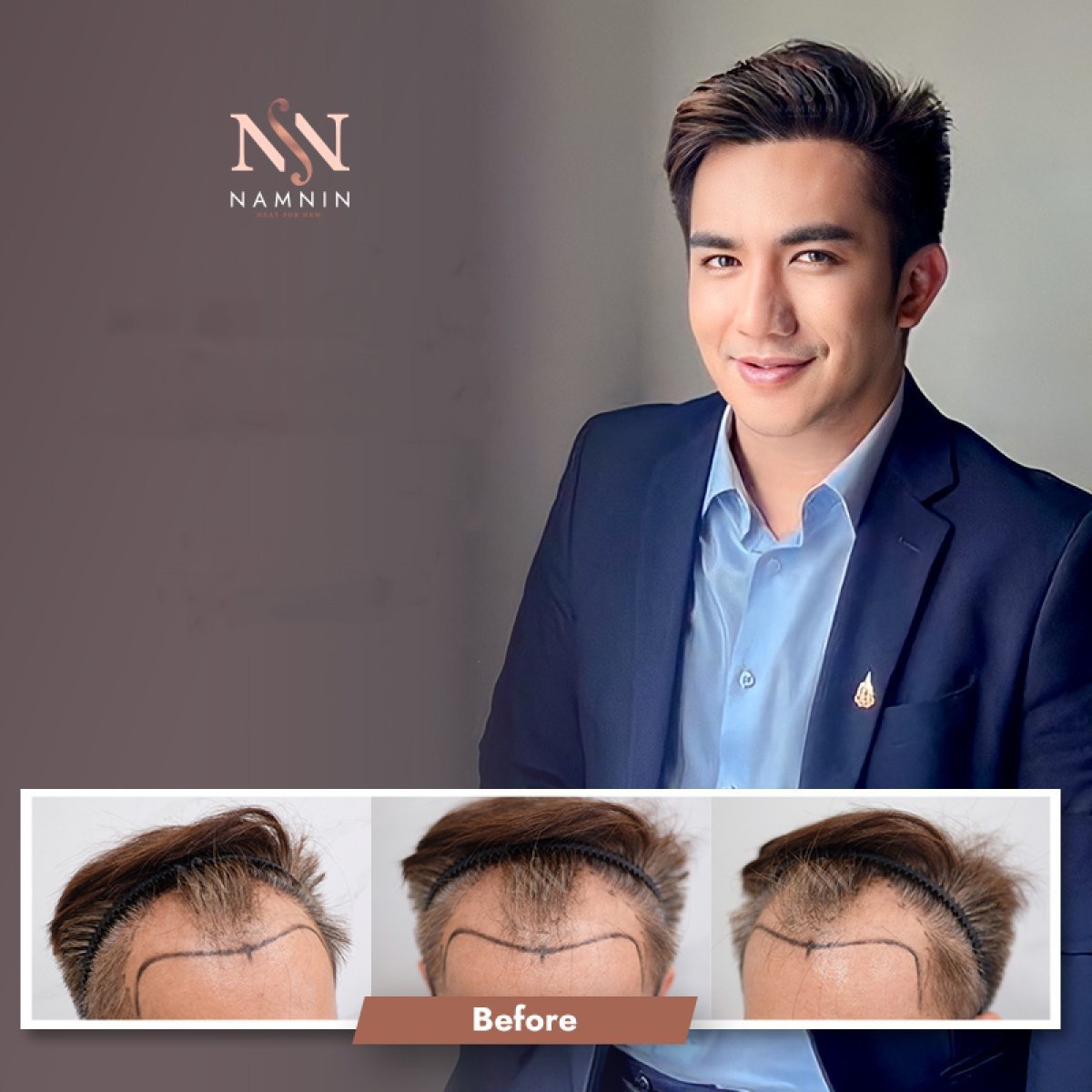 Resultados de trasplante capilar DHI antes y después en Namninforv Clinic, línea restaurada