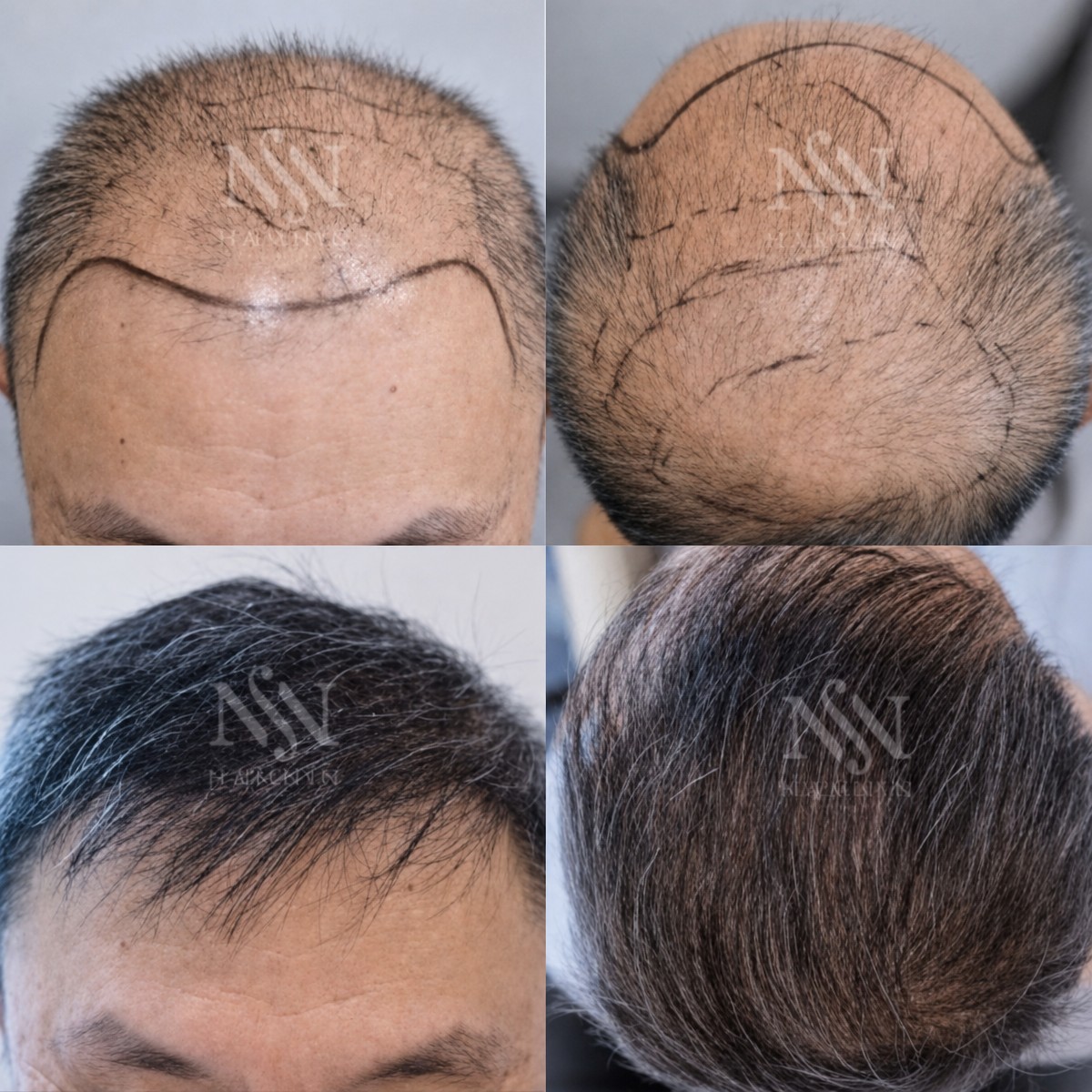Resultados antes y después de trasplante capilar FUE en Namninforv Clinic, densidad restaurada