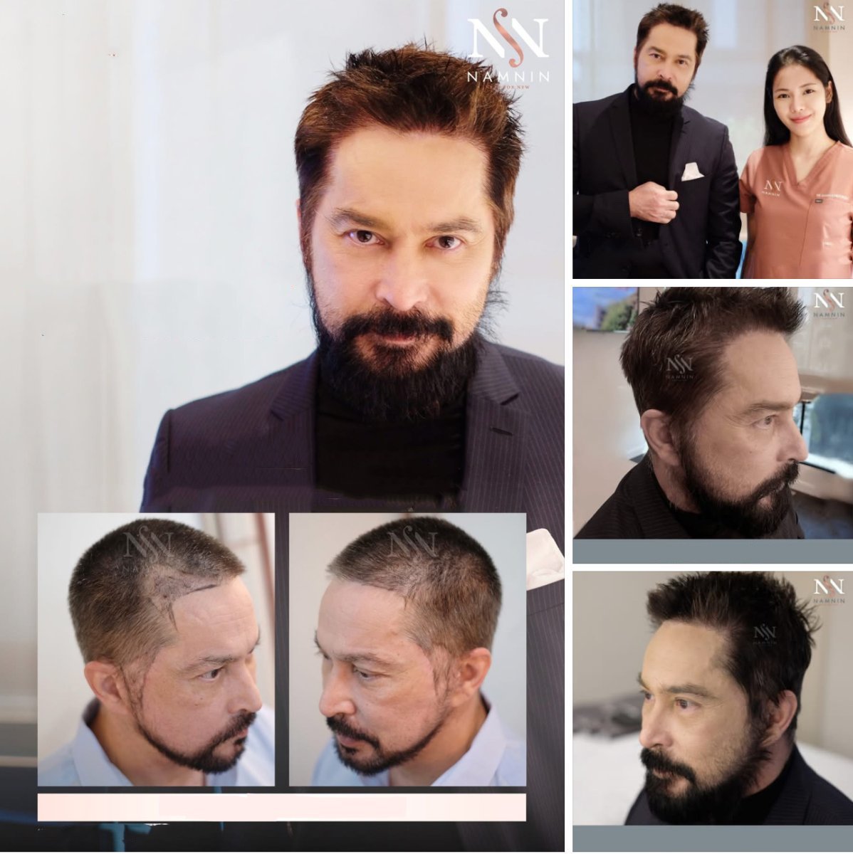 Результаты пересадки волос FUE до и после в Namninforv Clinic, улучшенная густота волос