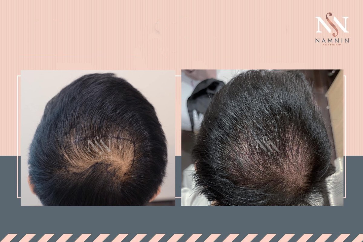 Efekty przeszczepu włosów No Shave przed i po w Namninforv Clinic, większa gęstość