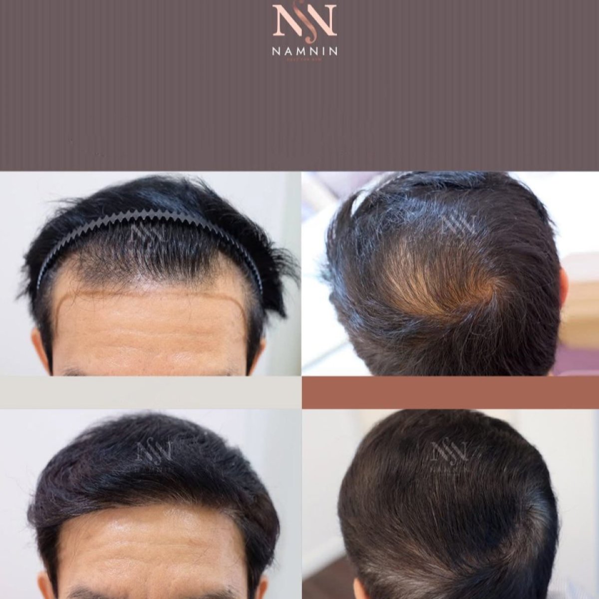 Before and after FUE hair transplant results at Namninforv Clinic, improved hair density
