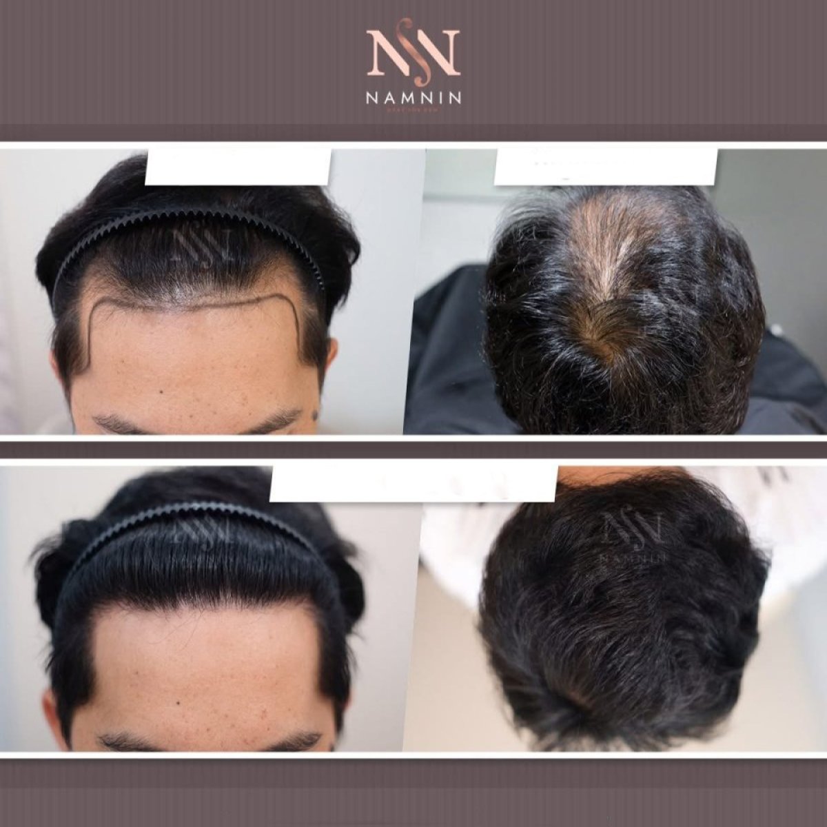 Resultados antes y después de trasplante capilar FUE en Namninforv Clinic, densidad restaurada