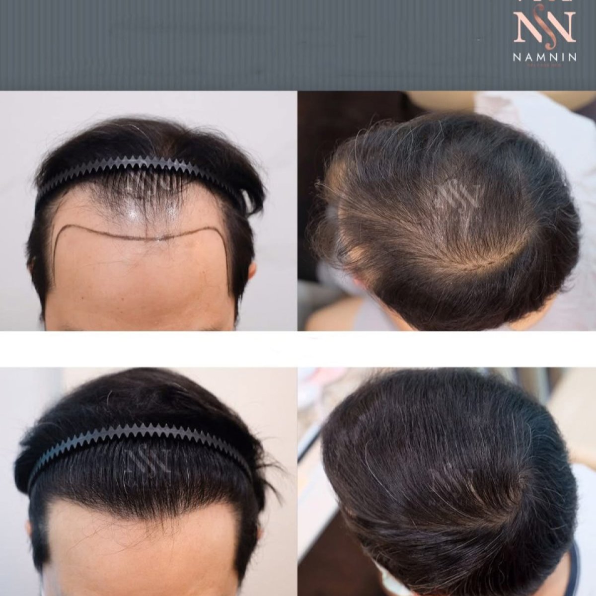 Before and after FUE hair transplant results at Namninforv Clinic, improved hair density