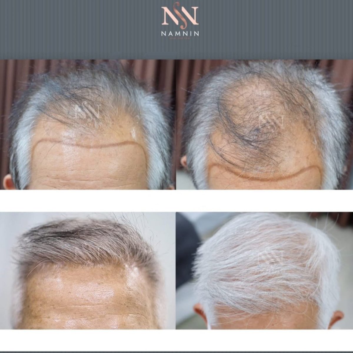 نتائج زراعة الشعر FUE قبل وبعد في عيادة Namninforv، كثافة شعر مستعادة