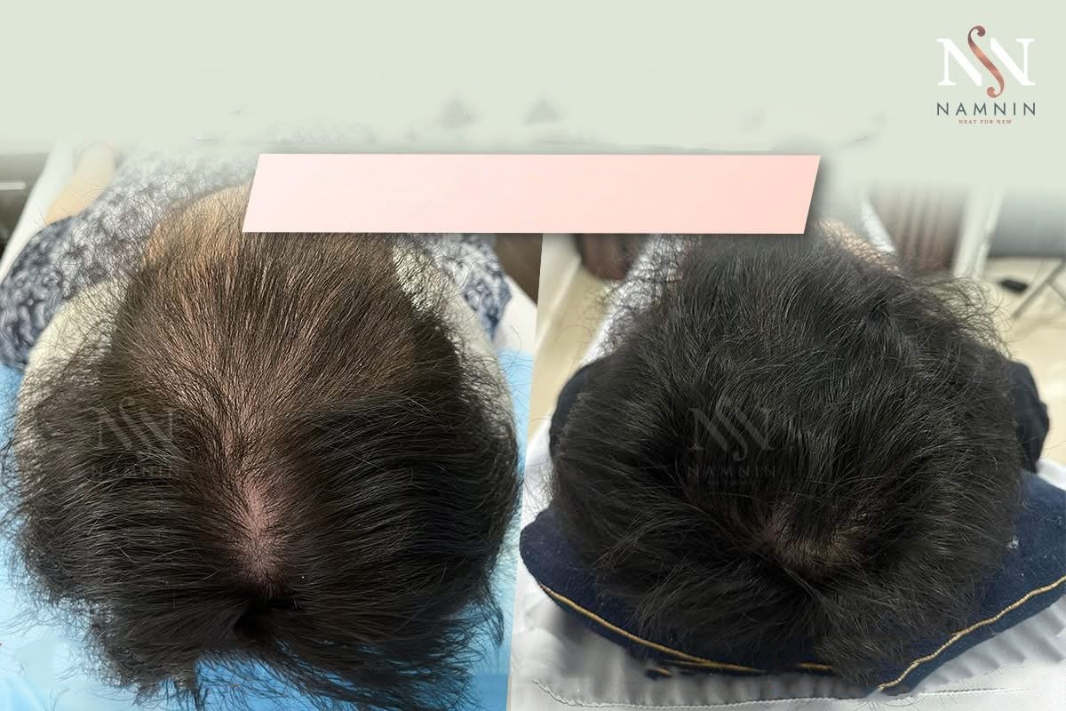 نتائج زراعة الشعر FUE قبل وبعد في عيادة Namninforv، كثافة شعر محسنة