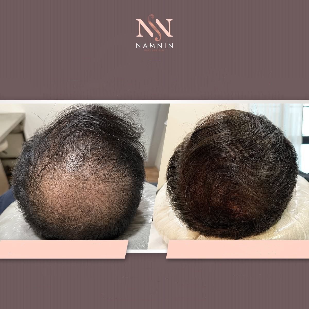 نتائج قبل وبعد زراعة الشعر FUE في عيادة Namninforv، كثافة شعر محسنة