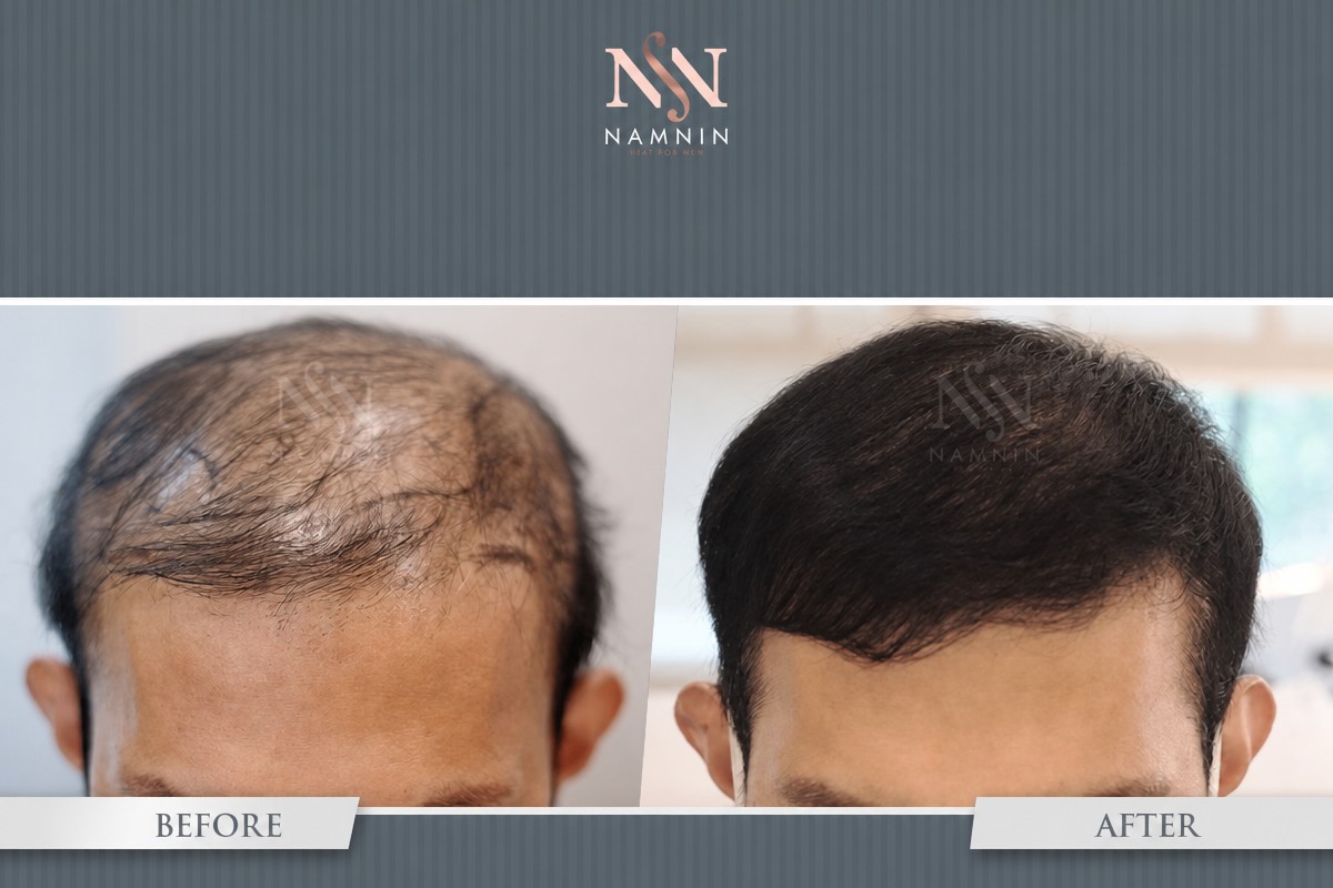 Resultado antes y después de trasplante capilar FUE en Namninforv Clinic, línea restaurada