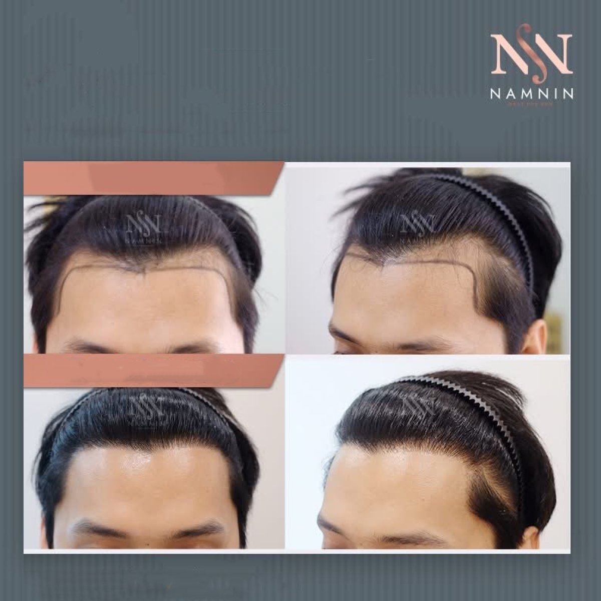 نتائج زراعة الشعر FUE قبل وبعد في عيادة Namninforv، كثافة خط الشعر المحسنة