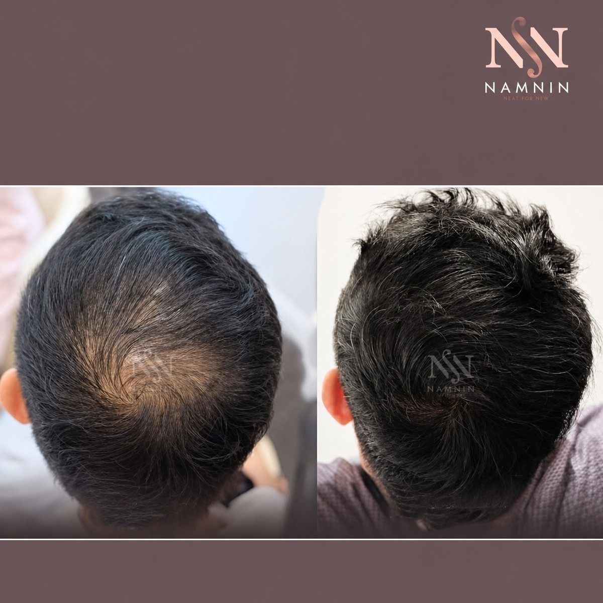 Before and after FUE hair transplant results at Namninforv Clinic, improved hair density