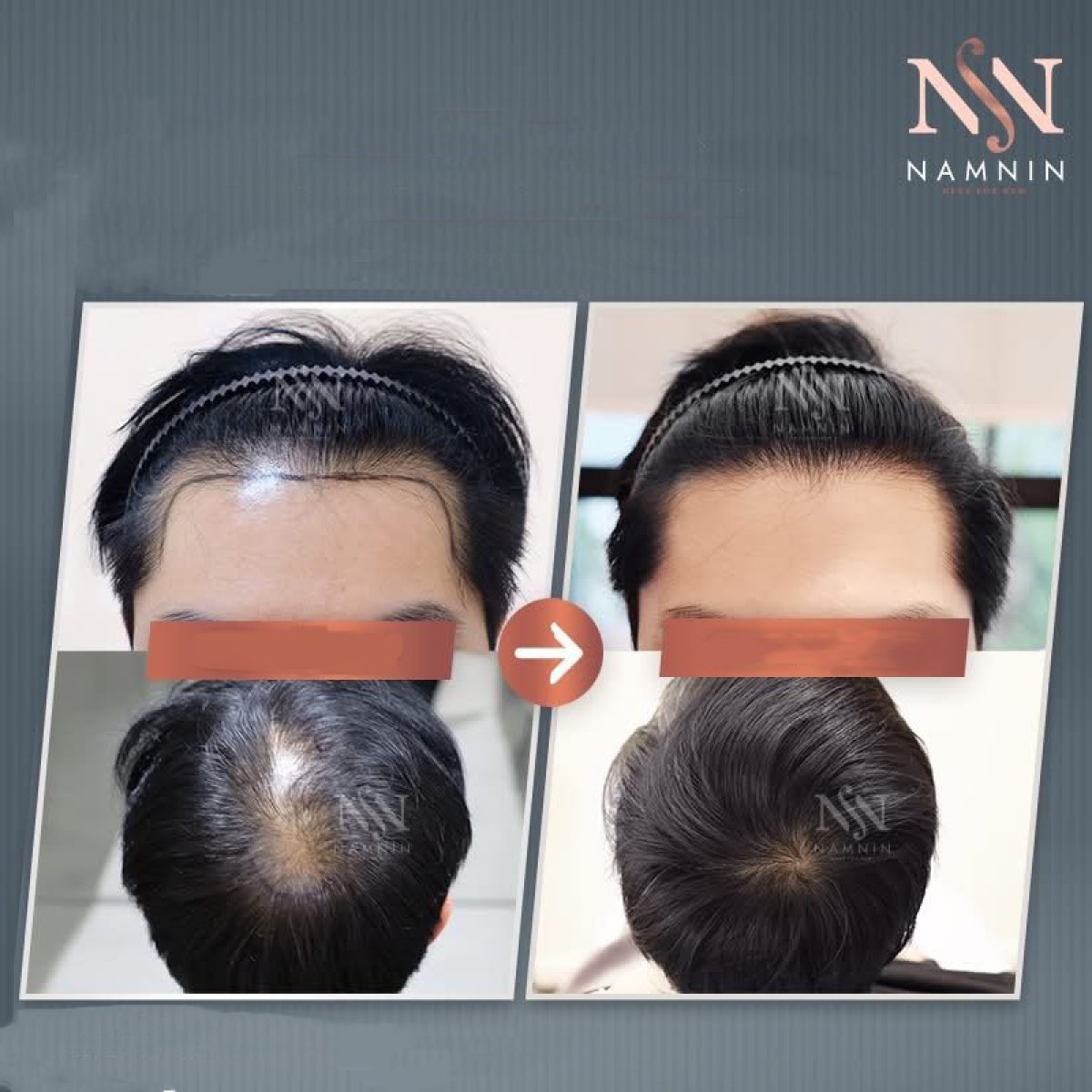 Resultados antes y después de trasplante capilar FUE en Namninforv Clinic, mayor densidad