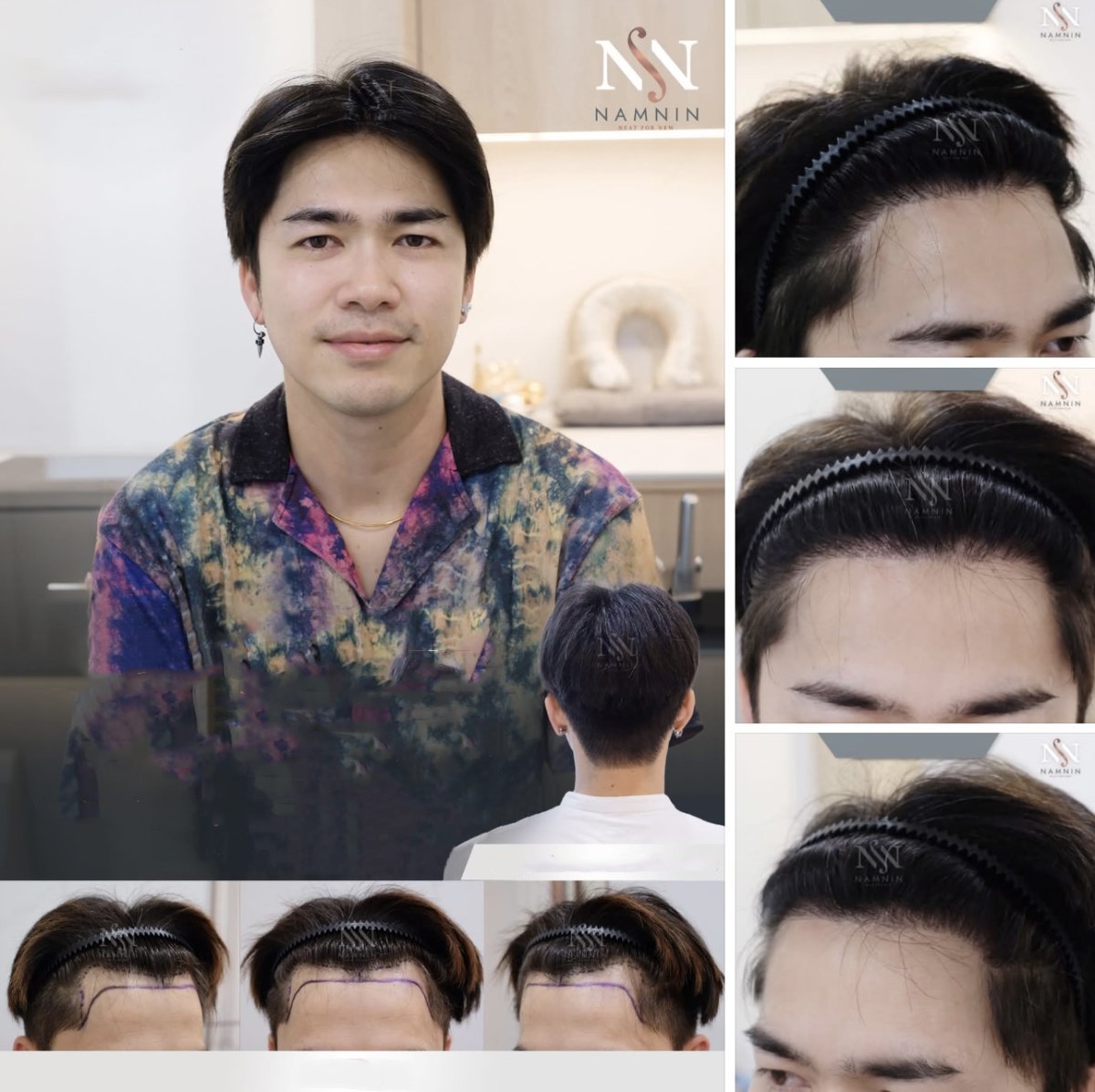 نتائج زراعة الشعر FUE في عيادة Namninforv – خط شعر أكثر كثافة لدى مريض ذكر