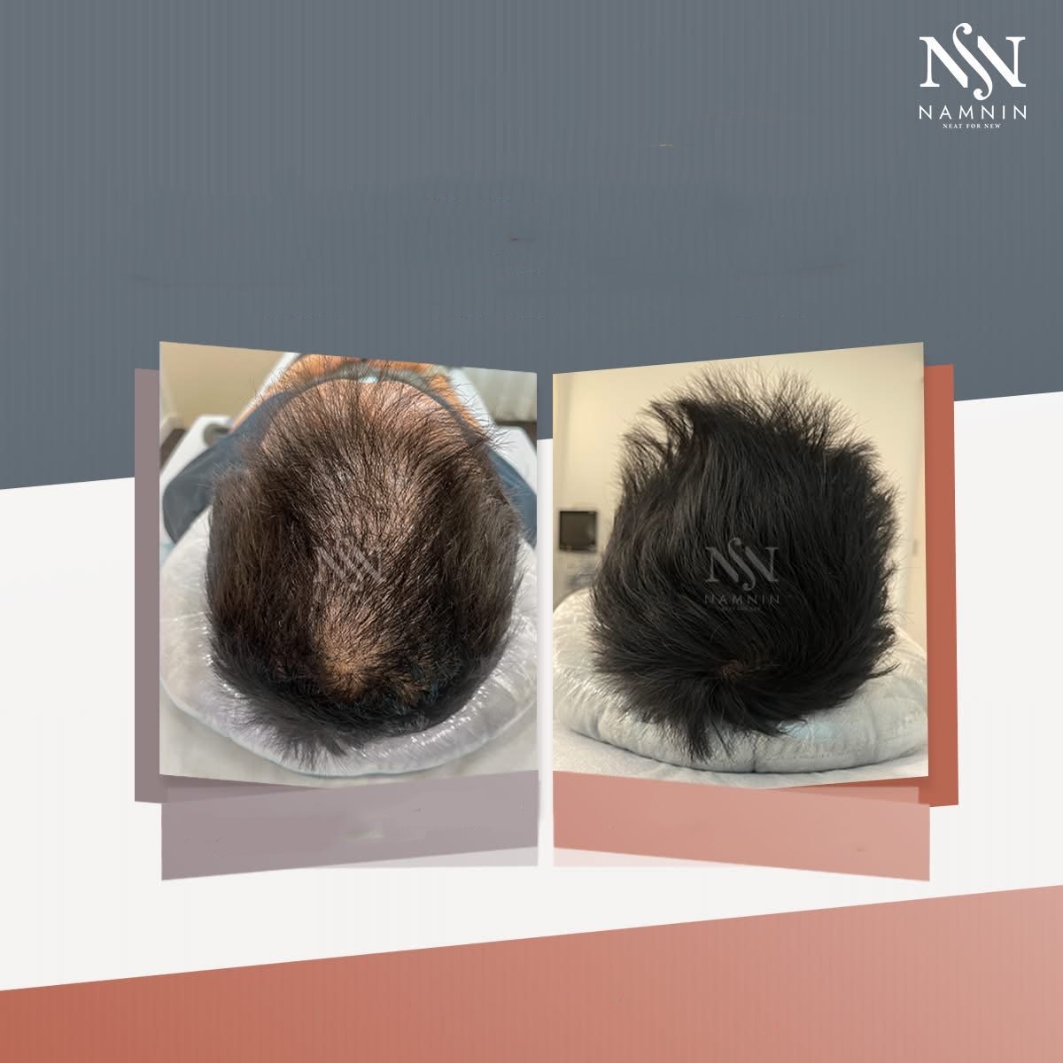 نتائج زراعة الشعر بتقنية FUE قبل وبعد في عيادة Namninforv، كثافة شعر محسّنة