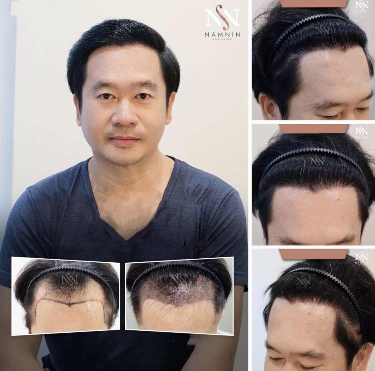 نتائج زراعة الشعر FUE قبل وبعد في عيادة Namninforv، كثافة خط الشعر المحسنة