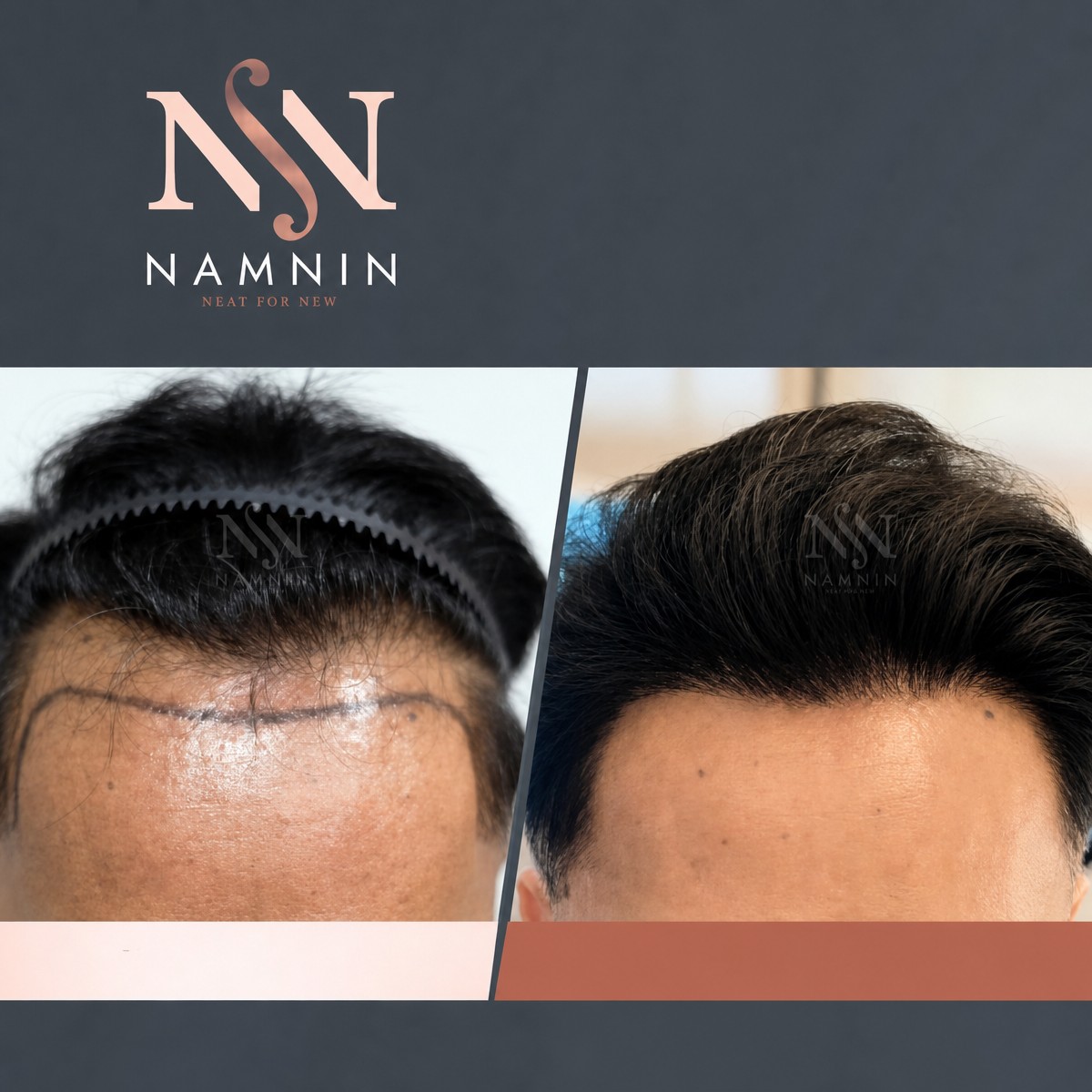 Before and after FUE hair transplant results at Namninforv Clinic, restored hairline