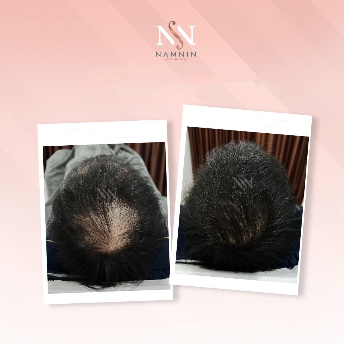 نتائج زراعة الشعر FUE قبل وبعد في عيادة Namninforv، كثافة شعر محسنة