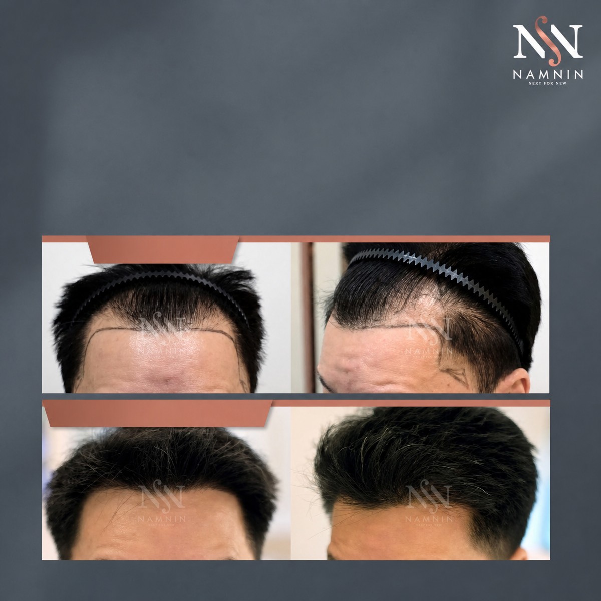 نتائج زراعة الشعر FUE قبل وبعد في عيادة Namninforv، كثافة خط الشعر المحسنة