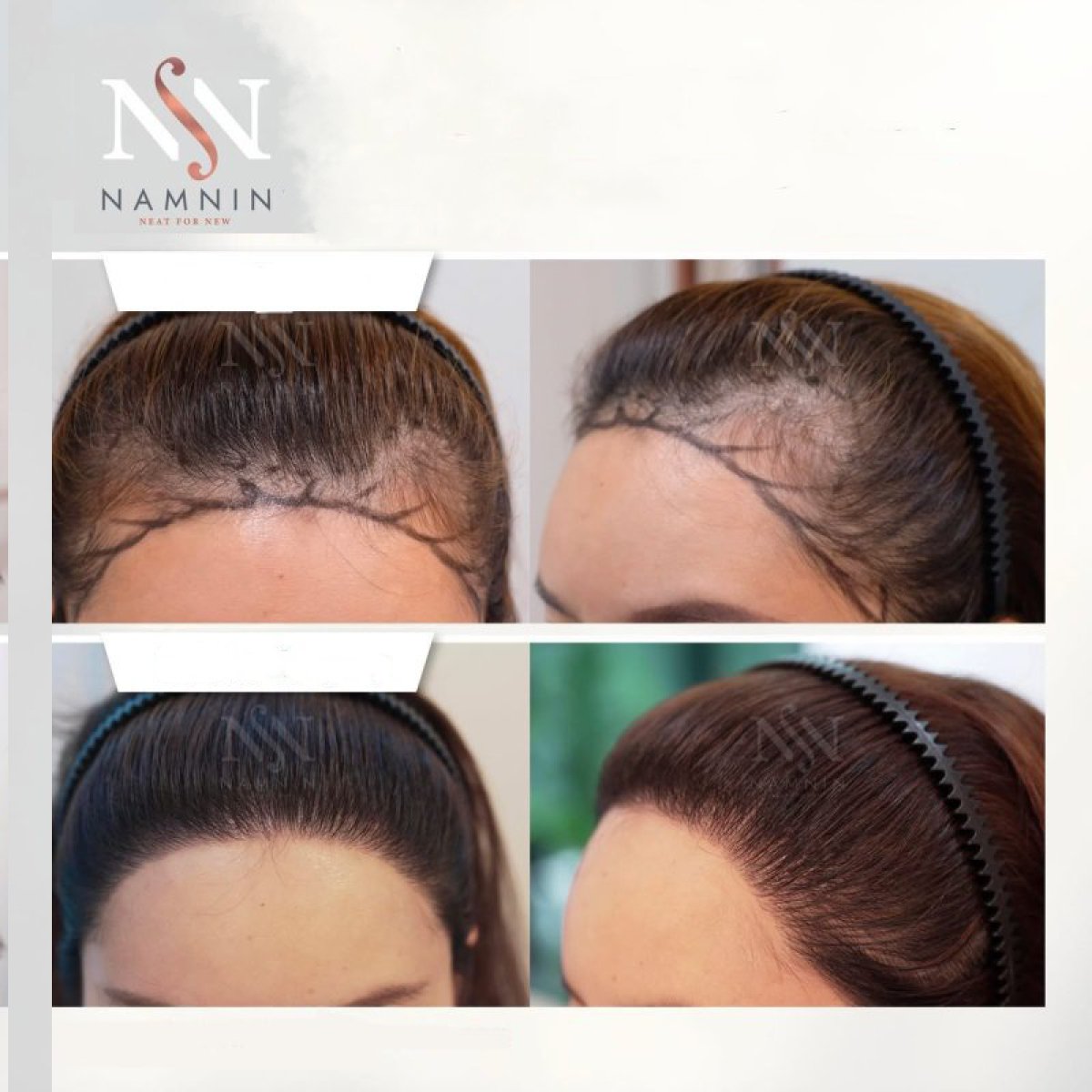 نتائج زراعة الشعر FUE قبل وبعد في عيادة Namninforv، كثافة خط الشعر المحسنة