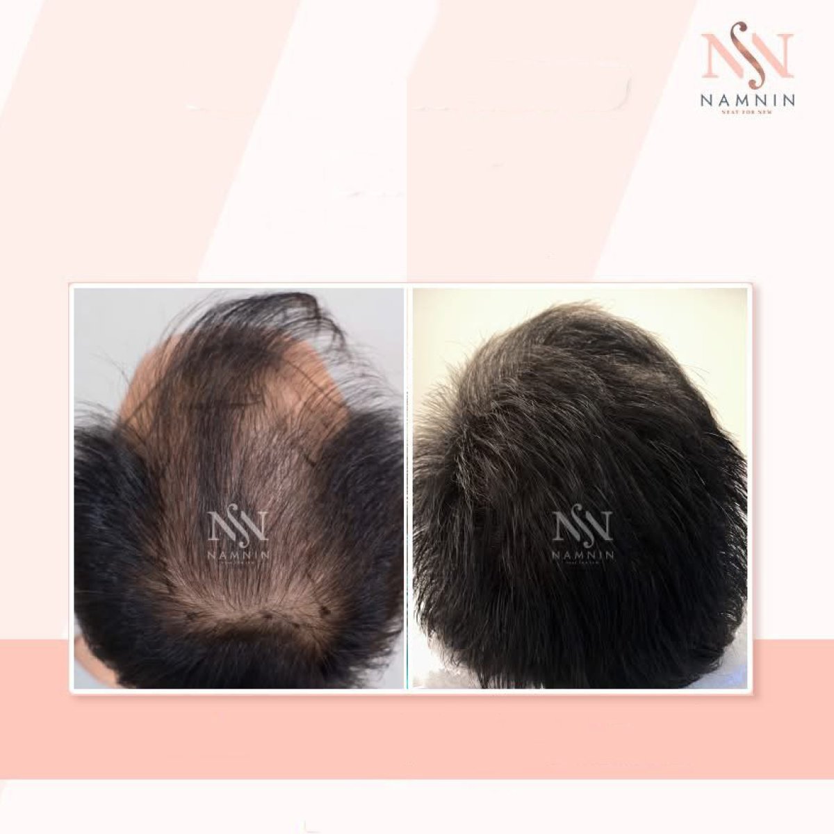 نتائج زراعة الشعر FUE قبل وبعد في عيادة Namninforv، كثافة شعر محسّنة