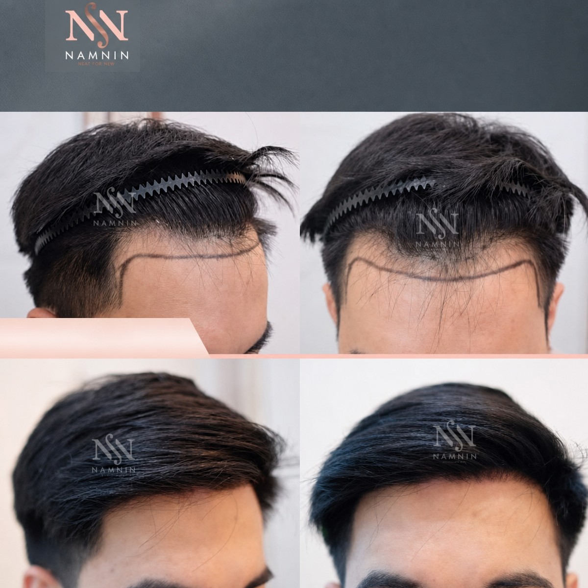 Résultats avant/après greffe de cheveux FUE à Namninforv Clinic, ligne capillaire restaurée