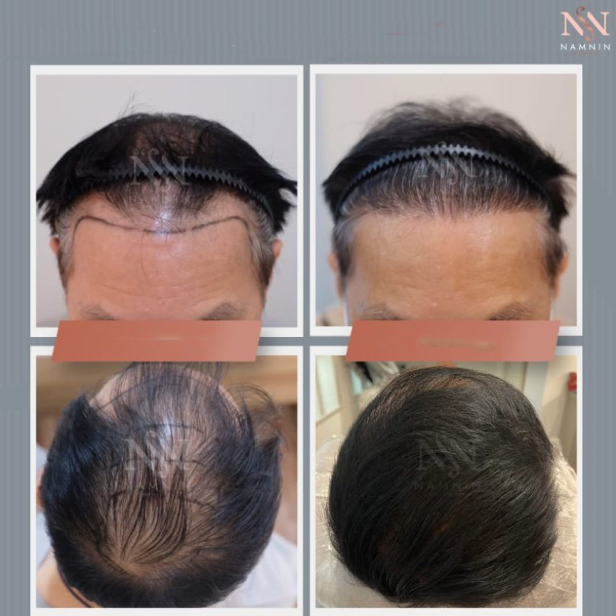 Before and after FUE hair transplant results at Namninforv Clinic, improved hair density