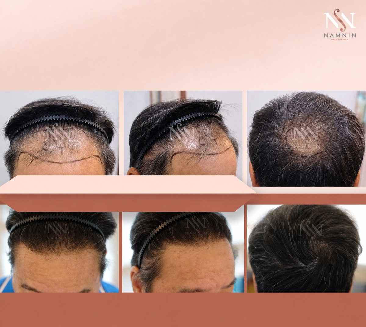 Résultats avant/après greffe de cheveux FUE à Namninforv Clinic, densité améliorée