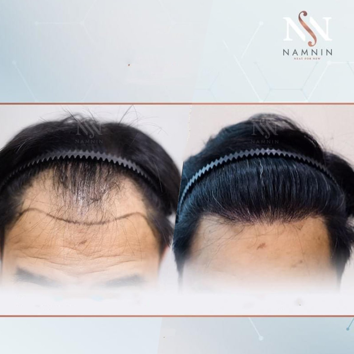 Before and after FUE hair transplant results at Namninforv Clinic, improved hairline density