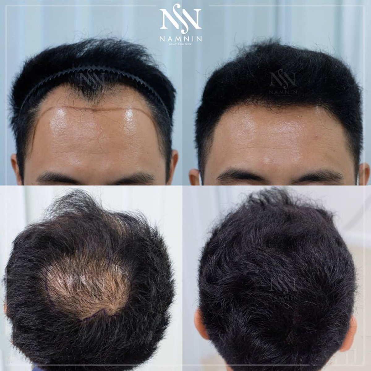 Resultados antes y después de trasplante capilar FUE en Namninforv Clinic, densidad restaurada