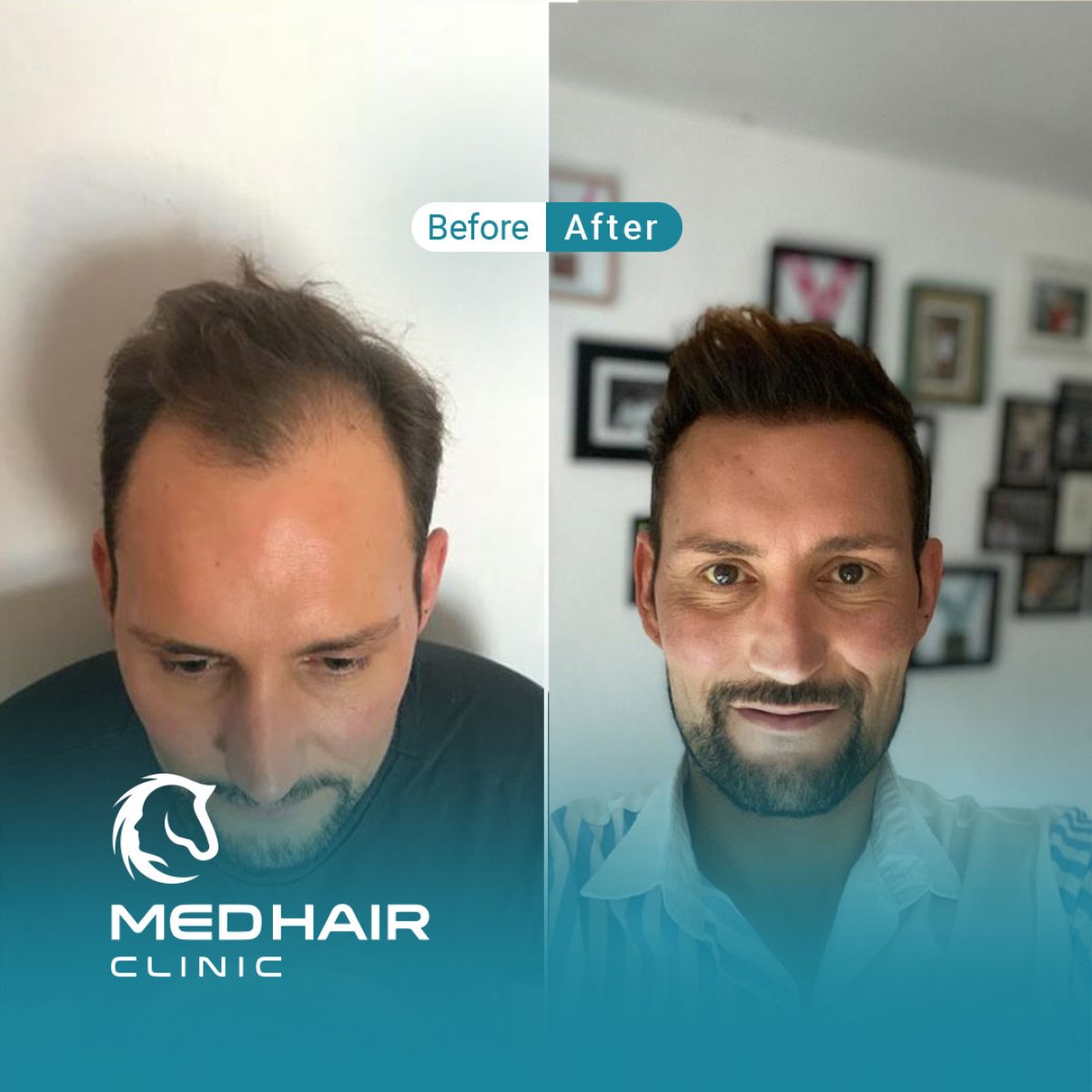 نتائج زراعة الشعر بتقنية FUE قبل وبعد في MedHair Clinic، استعادة خط الشعر للرجال