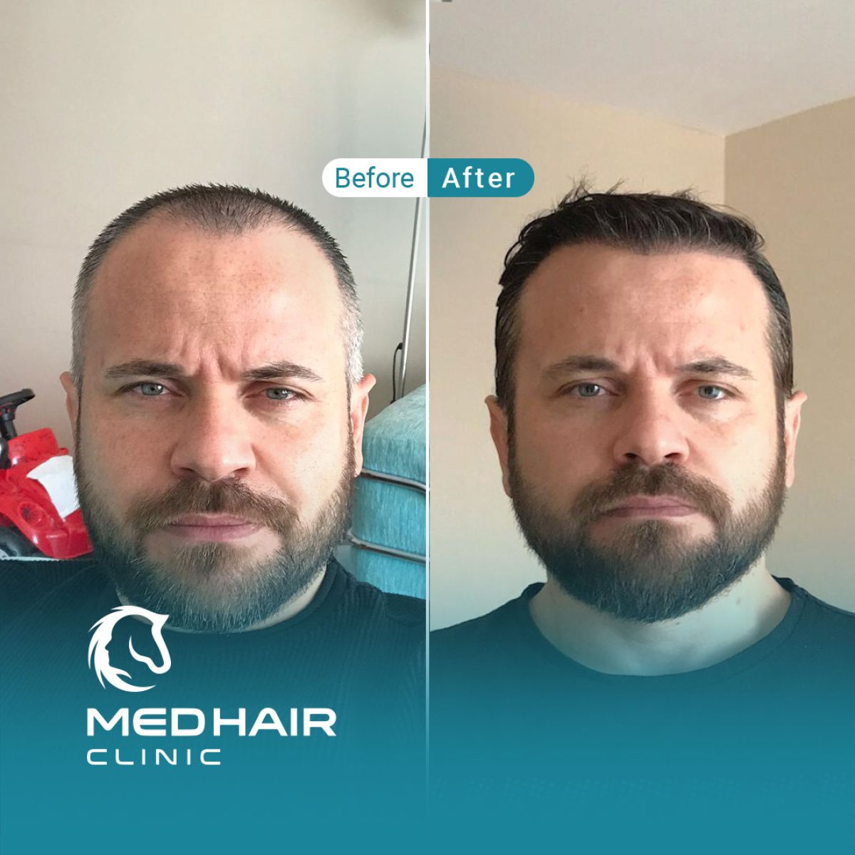 Before and after FUE hair transplant results at MedHair Clinic showing fuller hairline